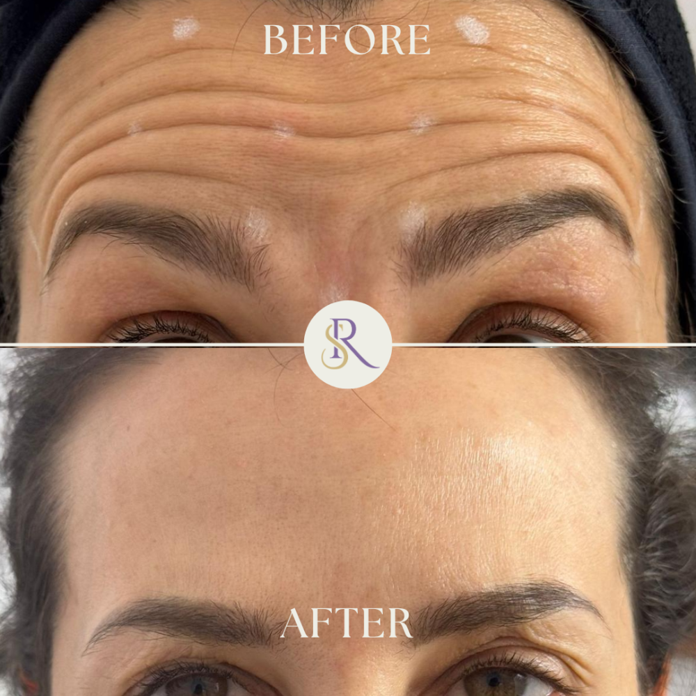 Botox: De la Descoperire la Realitate