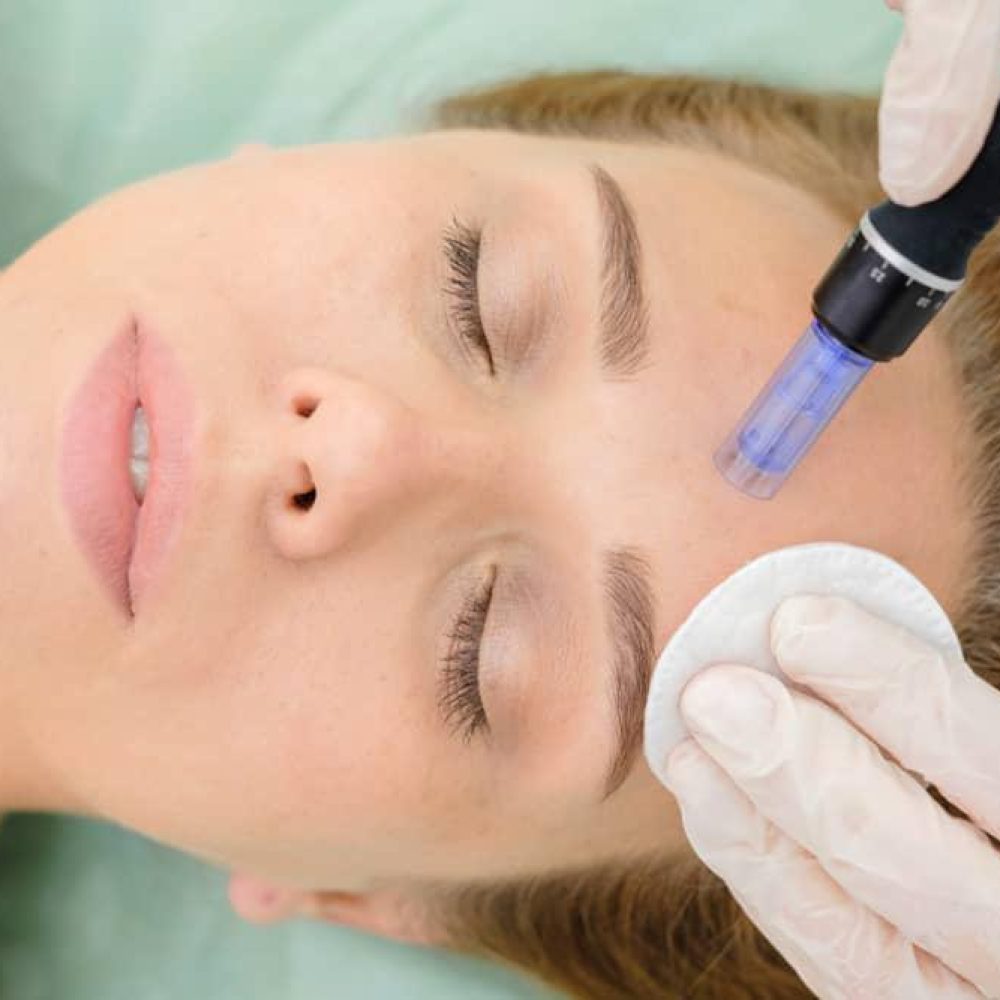 Microneedling vs. Laserele CO2 în Tratamentul Cicatricilor de Acnee: O Alternativă Sigură și Versatilă