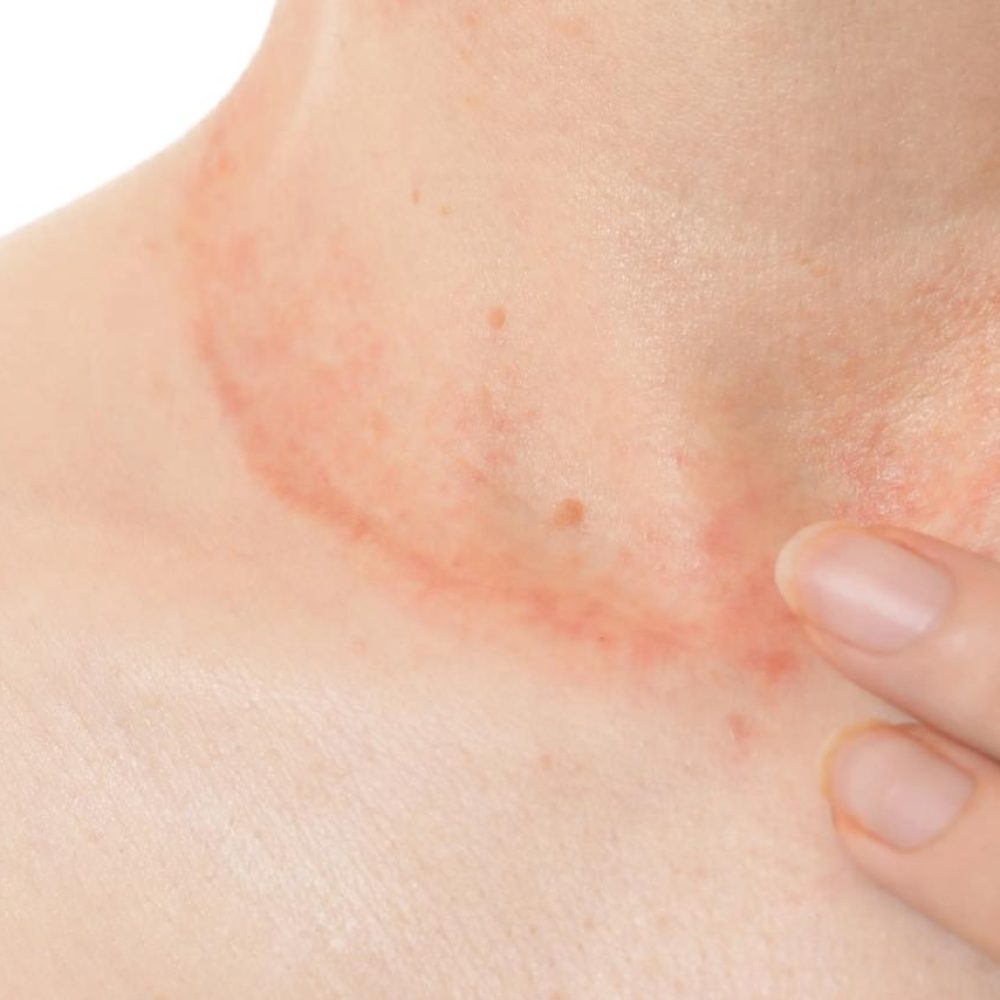 Dermatita Atopică la Copii și Adulți: Cauze, Gestionare și Rutine Personalizate
